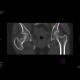 Acetabular fracture, posterior dislocation of the femoral head, dashboad injury: CT - Computed tomography